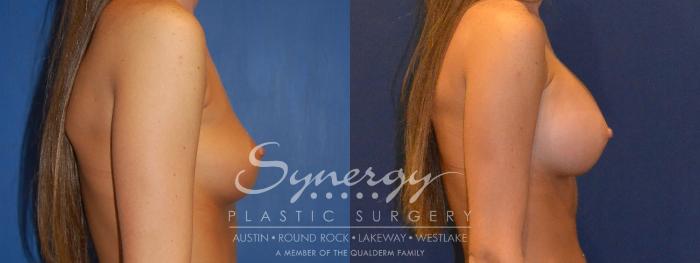 Before & After Breast Augmentation Case 304 View #2 View in Austin, TX