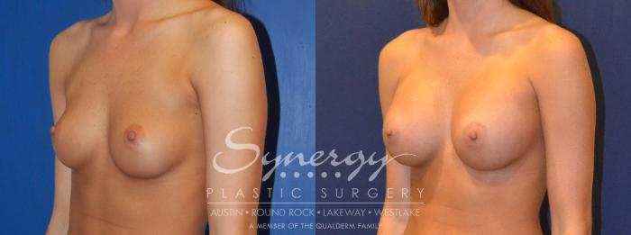 Before & After Breast Augmentation Case 304 View #4 View in Austin, TX
