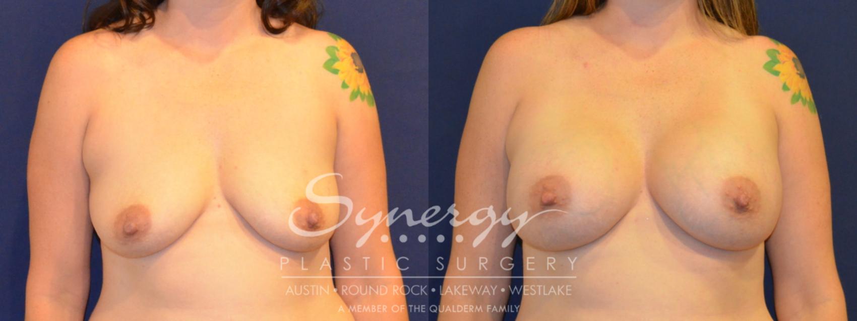 Before & After Breast Augmentation Case 305 View #1 View in Austin, TX