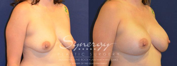 Before & After Breast Augmentation Case 305 View #3 View in Austin, TX
