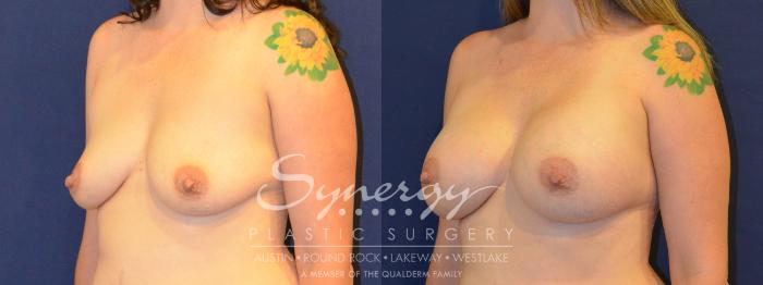 Before & After Breast Augmentation Case 305 View #4 View in Austin, TX