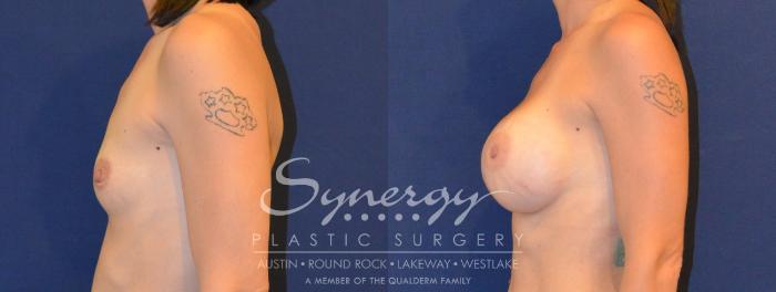 Before & After Breast Augmentation Case 307 View #4 View in Austin, TX