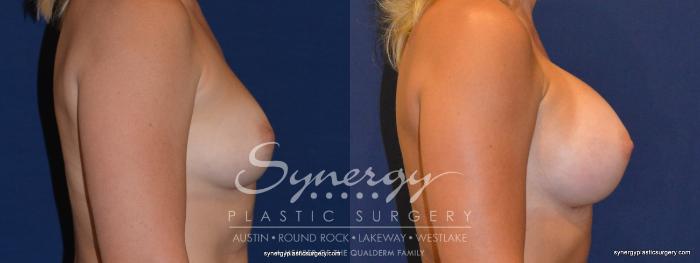 Before & After Breast Augmentation Case 311 View #2 View in Austin, TX