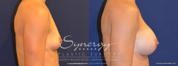 Before & After Breast Augmentation Case 312 View #2 View in Austin, TX