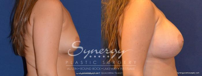 Before & After Breast Augmentation Case 313 View #2 View in Austin, TX