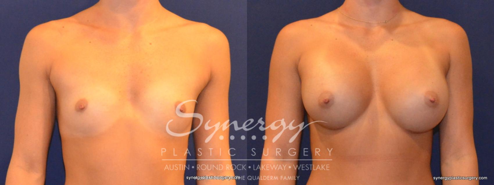 Before & After Breast Augmentation Case 314 View #1 View in Austin, TX