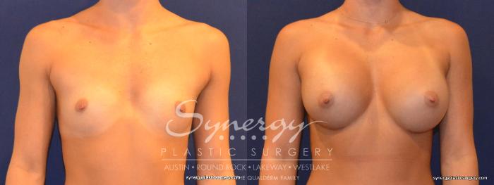 Before & After Breast Augmentation Case 314 View #1 View in Austin, TX