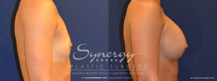 Before & After Breast Augmentation Case 314 View #2 View in Austin, TX