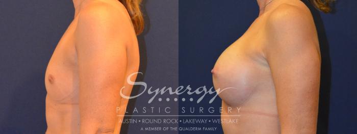 Before & After Breast Augmentation Case 317 View #4 View in Austin, TX