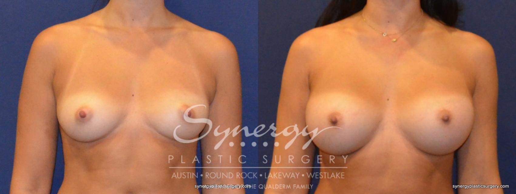 Before & After Breast Augmentation Case 321 View #1 View in Austin, TX