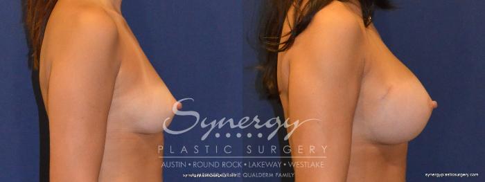 Before & After Breast Augmentation Case 321 View #2 View in Austin, TX