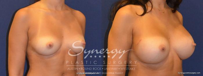 Before & After Breast Augmentation Case 321 View #3 View in Austin, TX