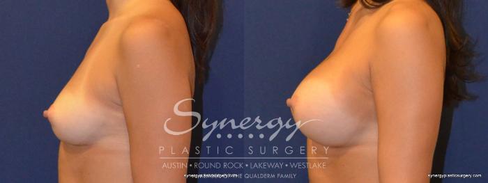 Before & After Breast Augmentation Case 321 View #4 View in Austin, TX