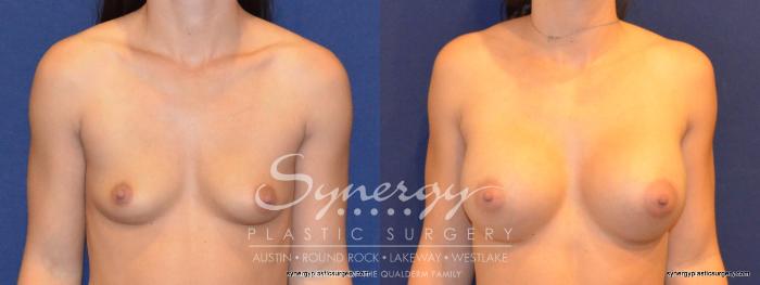 Before & After Breast Augmentation Case 322 View #1 View in Austin, TX