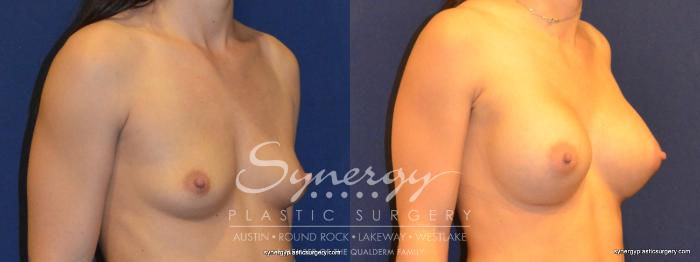 Before & After Breast Augmentation Case 322 View #2 View in Austin, TX