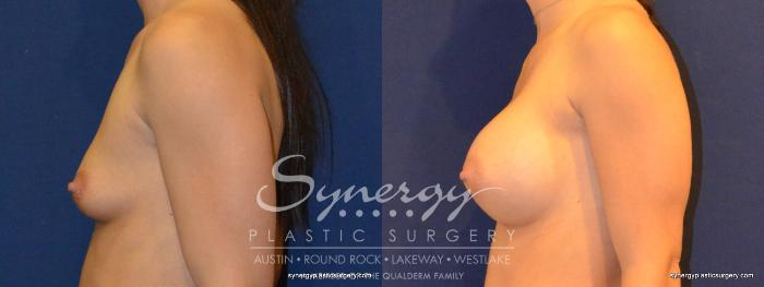 Before & After Breast Augmentation Case 322 View #5 View in Austin, TX