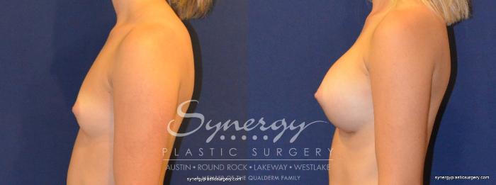 Before & After Breast Augmentation Case 327 View #4 View in Austin, TX