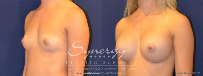 Before & After Breast Augmentation Case 327 View #5 View in Austin, TX