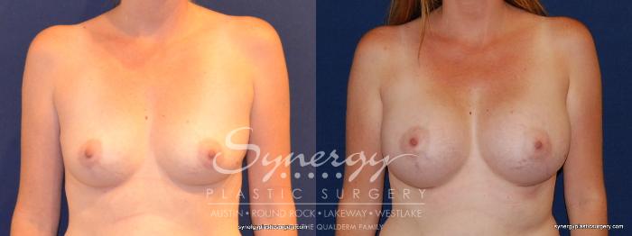 Before & After Breast Augmentation Case 330 View #1 View in Austin, TX