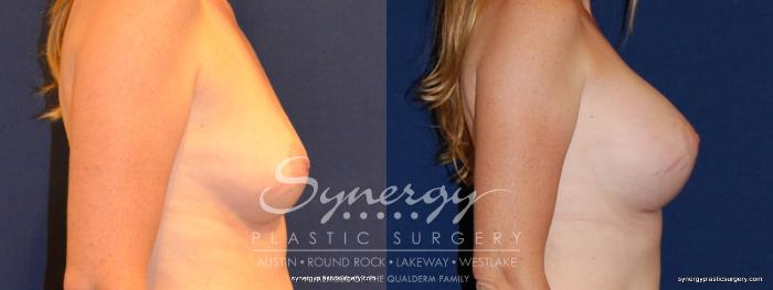 Before & After Breast Augmentation Case 330 View #2 View in Austin, TX