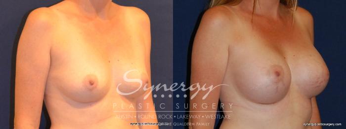 Before & After Breast Augmentation Case 330 View #3 View in Austin, TX