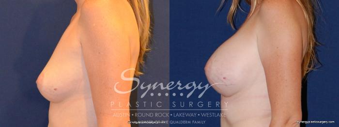 Before & After Breast Augmentation Case 330 View #4 View in Austin, TX