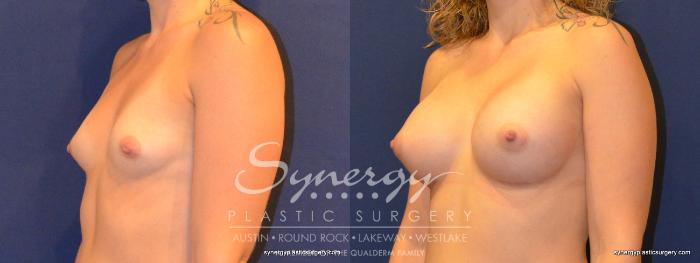 Before & After Breast Augmentation Case 341 View #4 View in Austin, TX