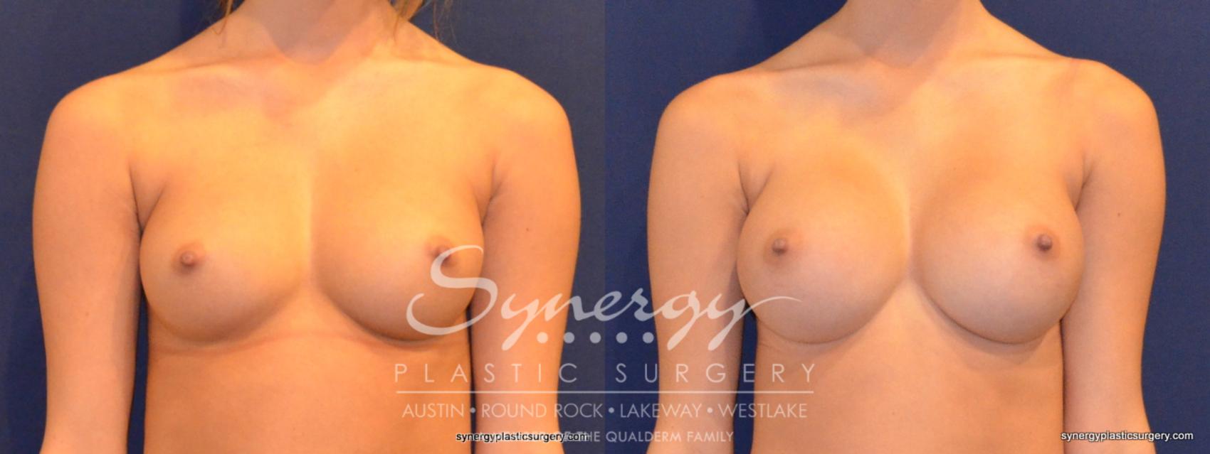 Before & After Breast Augmentation Case 343 View #1 View in Austin, TX