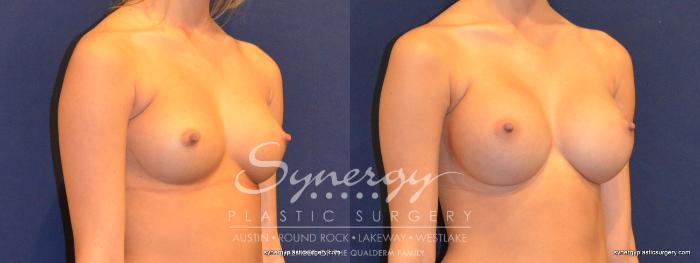 Before & After Breast Augmentation Case 343 View #3 View in Austin, TX