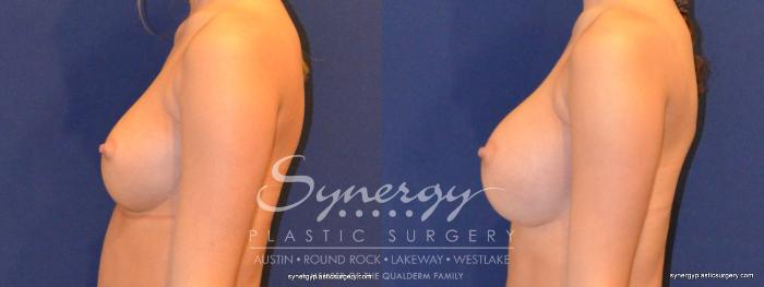 Before & After Breast Augmentation Case 343 View #4 View in Austin, TX