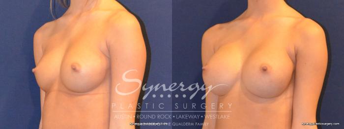 Before & After Breast Augmentation Case 343 View #5 View in Austin, TX
