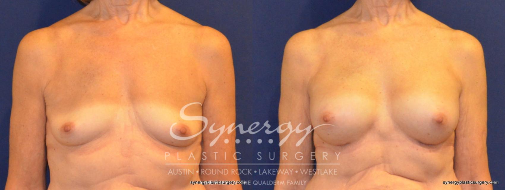 Before & After Breast Augmentation Case 346 View #1 View in Austin, TX