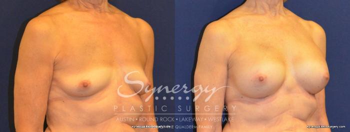 Before & After Breast Augmentation Case 346 View #2 View in Austin, TX