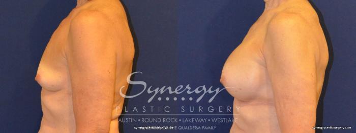 Before & After Breast Augmentation Case 346 View #4 View in Austin, TX