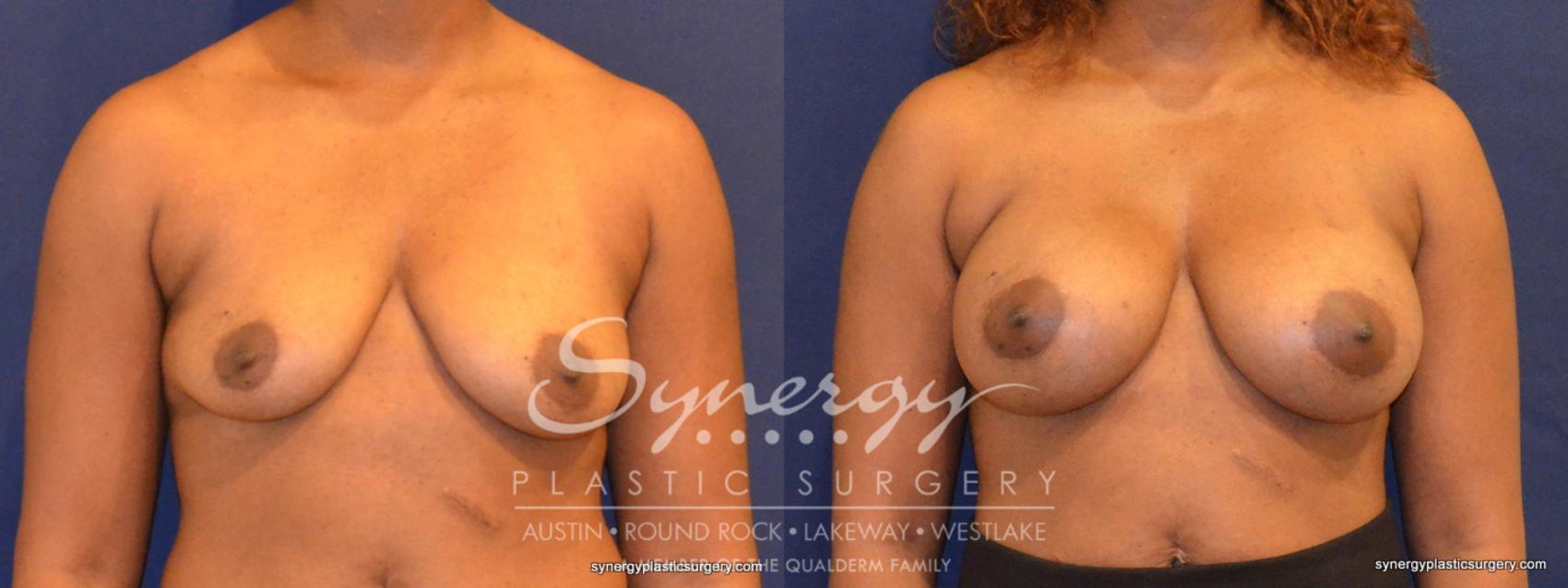 Before & After Breast Augmentation Case 347 View #1 View in Austin, TX