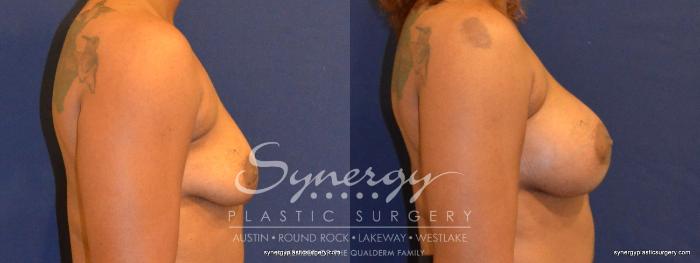Before & After Breast Augmentation Case 347 View #2 View in Austin, TX