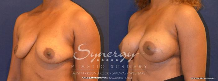 Before & After Breast Augmentation Case 347 View #5 View in Austin, TX