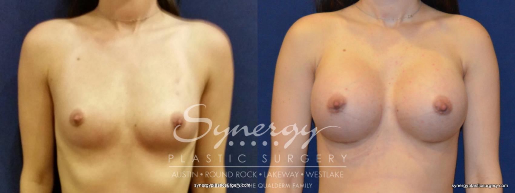 Before & After Breast Augmentation Case 350 View #1 View in Austin, TX