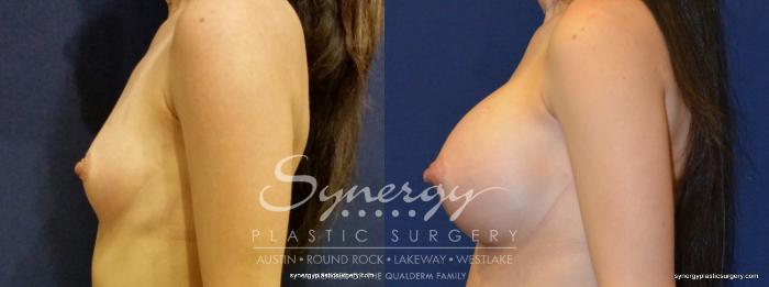 Before & After Breast Augmentation Case 350 View #4 View in Austin, TX