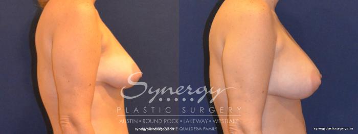 Before & After Breast Augmentation Case 351 View #2 View in Austin, TX