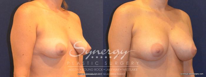 Before & After Breast Augmentation Case 351 View #3 View in Austin, TX
