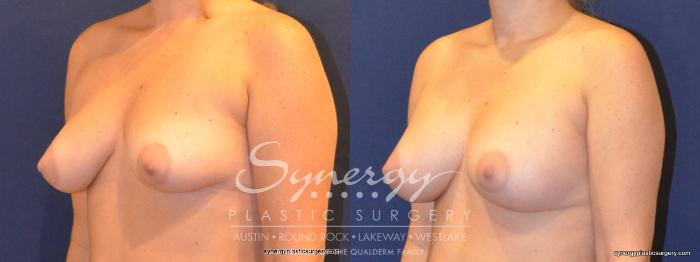 Before & After Breast Augmentation Case 351 View #4 View in Austin, TX