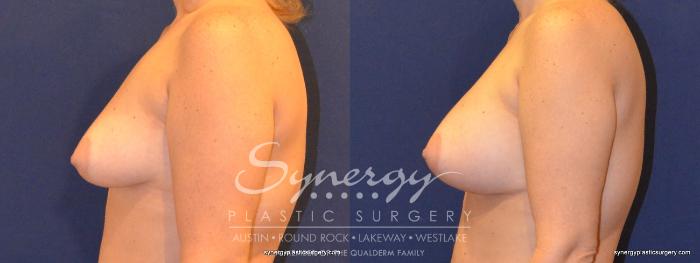 Before & After Breast Augmentation Case 351 View #5 View in Austin, TX