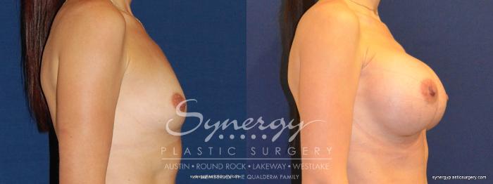 Before & After Breast Augmentation Case 352 View #2 View in Austin, TX