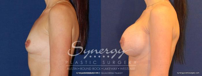 Before & After Breast Augmentation Case 352 View #4 View in Austin, TX