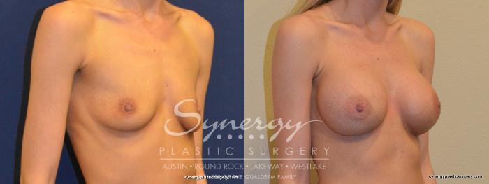 Before & After Breast Augmentation Case 355 View #2 View in Austin, TX