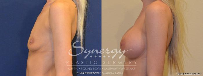Before & After Breast Augmentation Case 355 View #4 View in Austin, TX