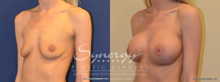 Before & After Breast Augmentation Case 355 View #5 View in Austin, TX