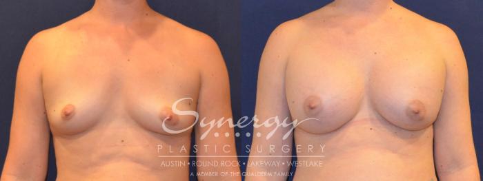 Before & After Breast Augmentation Case 357 View #1 View in Austin, TX