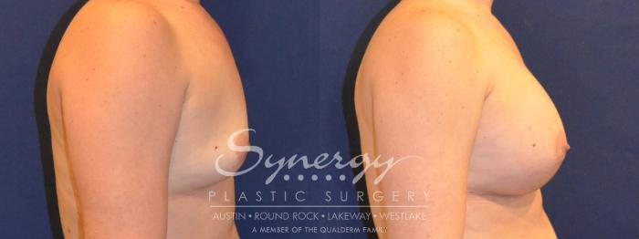Before & After Breast Augmentation Case 357 View #2 View in Austin, TX